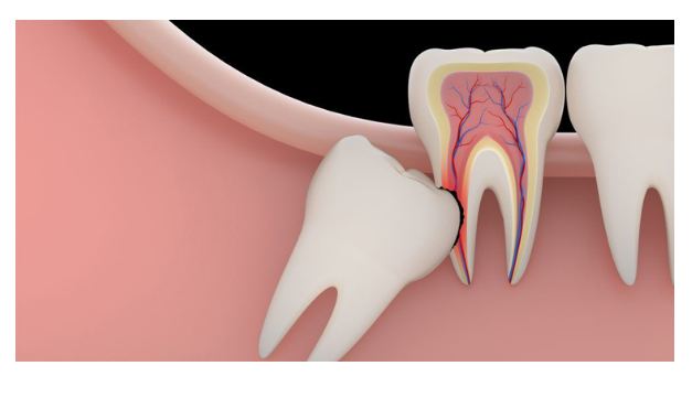 আক্কেল দাঁত উঠার সময় ব্যথা হয় কেন?
