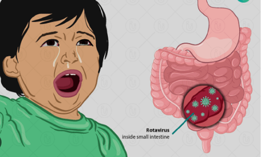 রোটাভাইরাস সংক্রমণ এর লক্ষণ