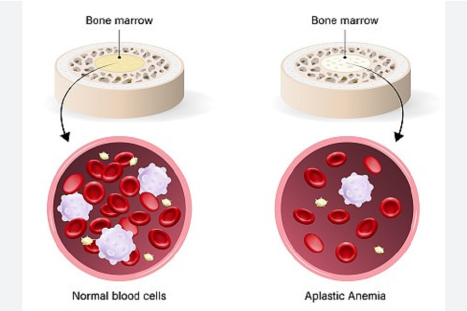 অ্যাপ্লাস্টিক অ্যানিমিয়া